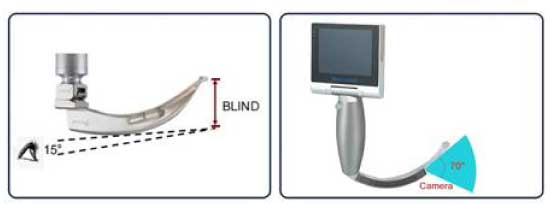 喉头镜/视频喉头镜是2